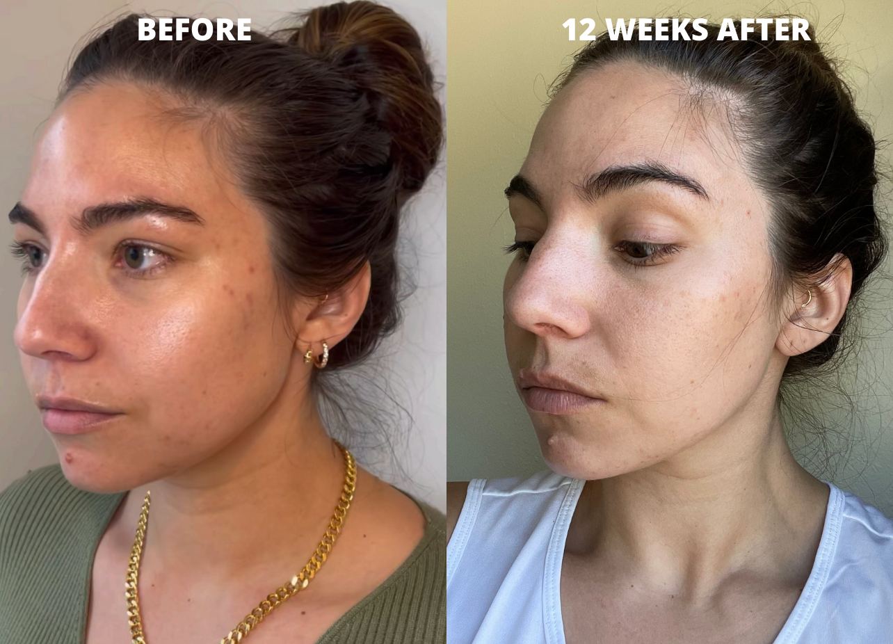 Cheek Augmentation