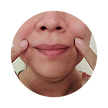 Perioral Lift